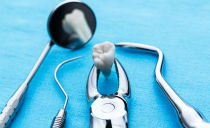 Que faire après une extraction dentaire: ce qui peut et ne peut pas