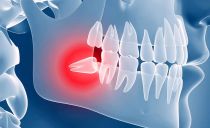 Dente do siso - remova ou trate como os dentes do siso são tratados e se dói