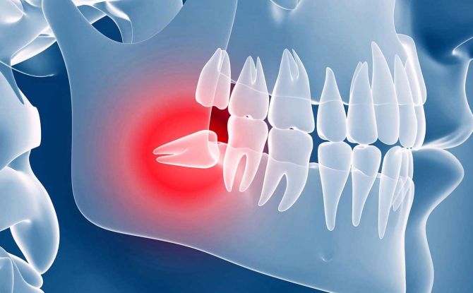 Dente del giudizio - rimuovi o tratta il modo in cui vengono trattati i denti del giudizio e se fa male