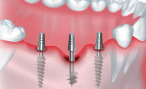 Basisimplantation: Was ist das, Vor- und Nachteile, Stadien der Installation von Zahnersatz, Komplikationen