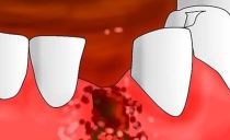 Alveolite após extração dentária: sintomas, fotos, tratamento na clínica e em casa
