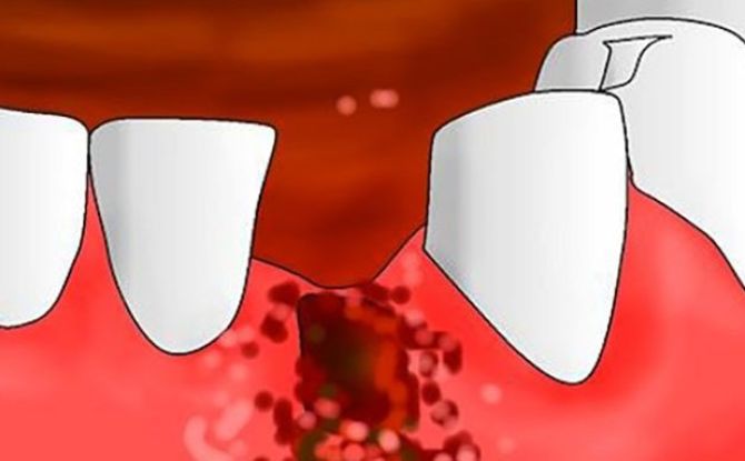 Alveolitis לאחר עקירת שיניים: סימפטומים, תמונות, טיפול במרפאה ובבית