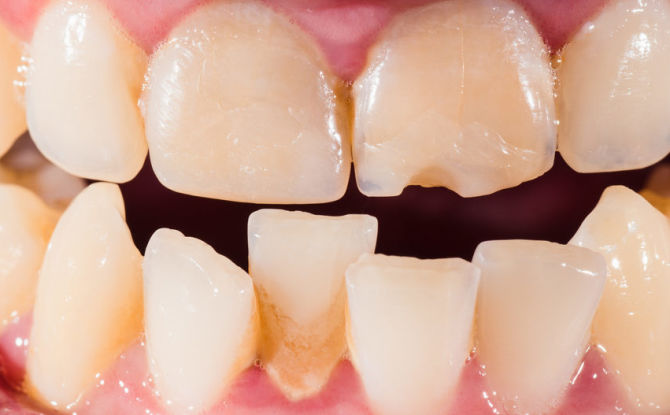 Gigi bengkok pada kanak-kanak dan orang dewasa: penyebab, kaedah pembetulan