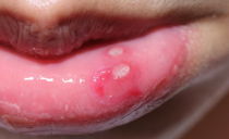 Sores on the lips from the inside and outside: types, causes, how and what to treat