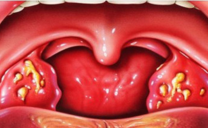 How to quickly cure purulent tonsillitis at home