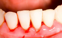 Orsaker, symtom, behandling och förebyggande av tandköttsinflammation
