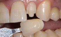 Teeth extension: how to build, photo before and after, pros and cons
