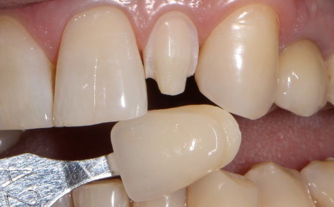 Sambungan gigi: bagaimana untuk membina, gambar sebelum dan selepas, kebaikan dan keburukan