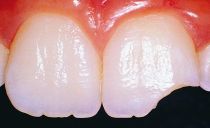 Årsaker til at tennene smuldrer sammen og hva du skal gjøre med det