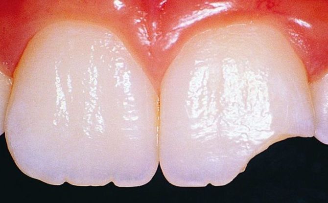 הסיבות לכך שהשיניים מתפוררות ומה לעשות בנידון