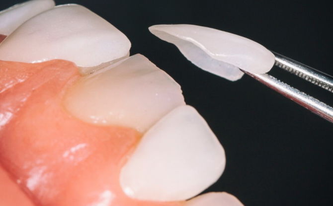 Almofadas de dentes: o que são e como são chamadas
