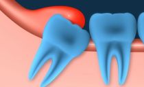 Gum inflamed and swollen near the wisdom tooth: causes, symptoms, treatment at the clinic and at home