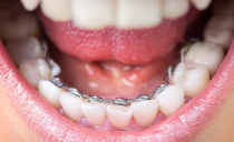 Lingual braces for bite correction: pros and cons, installation, types and cost