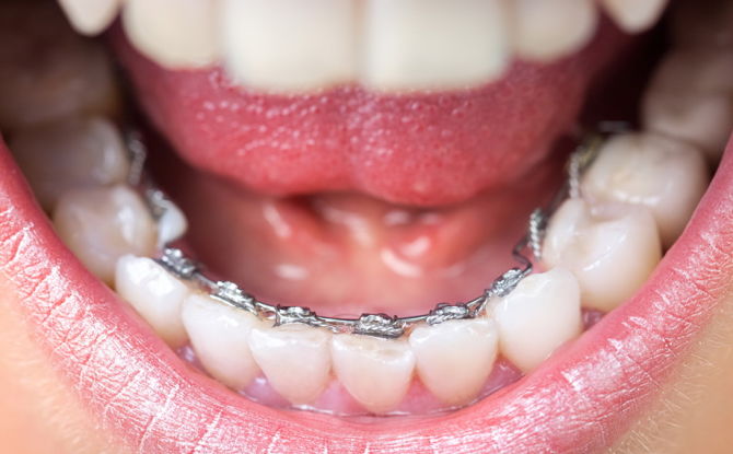เครื่องมือจัดฟันแบบ Lingual สำหรับการแก้ไขการกัด: ข้อดีข้อเสียการติดตั้งชนิดและค่าใช้จ่าย