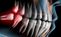 Mengeluarkan gigi kebijaksanaan di rahang bawah dan atas, akibat dan komplikasi yang mungkin