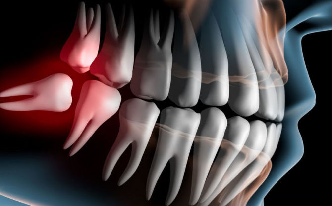 Mengeluarkan gigi kebijaksanaan di rahang bawah dan atas, akibat dan komplikasi yang mungkin