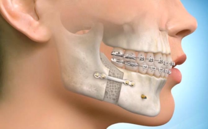 Fracturile maxilarului inferior și superior: clasificare, semne, simptome și tratament