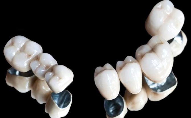 Ceramic-metal crowns: what it looks like, pros and cons, installation