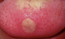 Stomatitis dalam lidah pada orang dewasa: sebab, gejala, jenis, bagaimana dan apa yang perlu dirawat