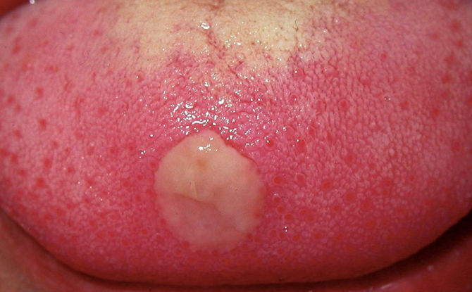 Stomatitis i tungen hos voksne: årsager, symptomer, typer, hvordan og hvad man skal behandle