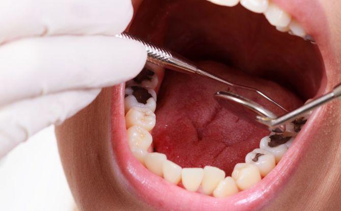 Tratamiento de caries dental: cómo tratar la odontología, etapas de eliminación de caries