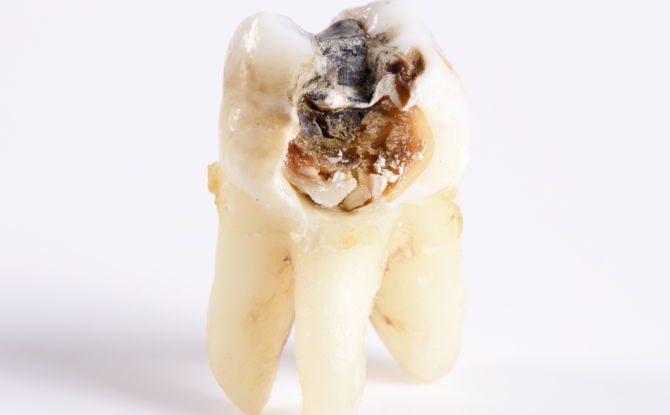 Răng bị sâu răng: nguyên nhân, hậu quả đối với cơ thể, phải làm gì với răng bị sâu