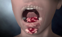 Cáncer oral: causas, síntomas, tratamiento y pronóstico para el cáncer de mejillas, paladar, lengua, encías y el fondo de la cavidad oral.