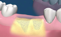 Extension du tissu osseux avant l'implantation dentaire: l'essence de la procédure, les méthodes, les étapes, le coût