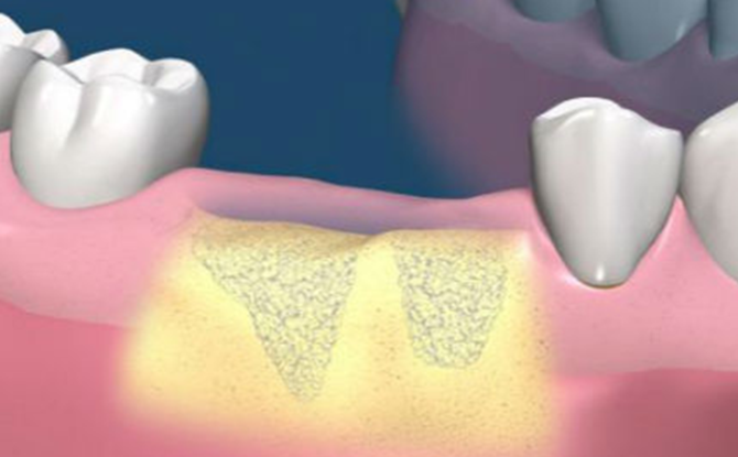 Przedłużenie tkanki kostnej przed implantacją zębów: istota zabiegu, metody, etapy, koszt