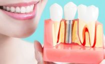 Kiek kainuoja įstatyti vieną danties implantą
