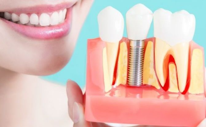 ¿Cuánto cuesta insertar un implante dental?