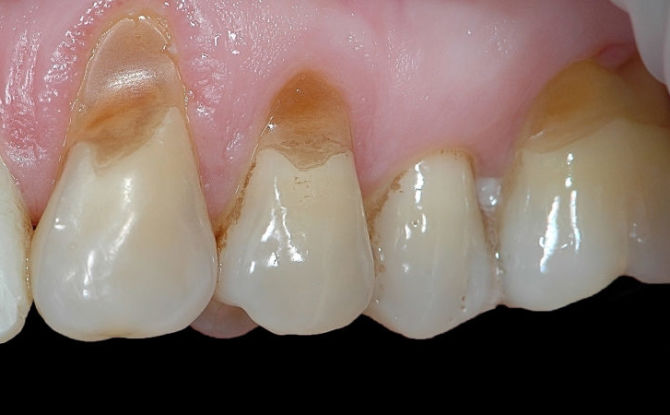 גורמים, סימנים וטיפול במום שיניים בצורת טריז
