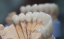 Zirconium crowns: pros and cons, differences, indications for installation