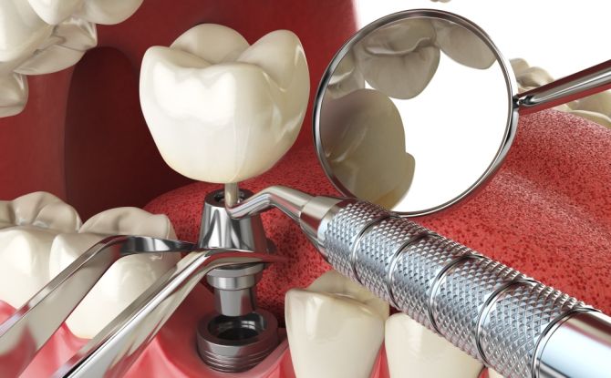 Dental implants - contraindications and possible complications