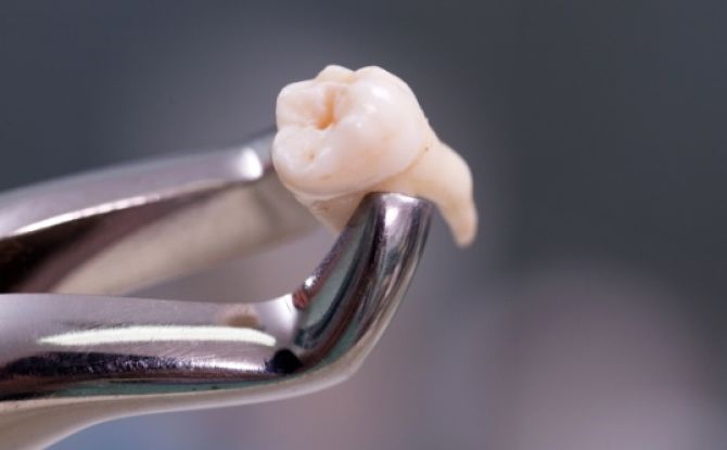 Po danties ištraukimo skauda dantenas - kodėl ir ką daryti