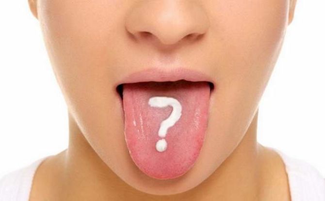 What does white plaque say in an adult's tongue: 15 reasons and treatment