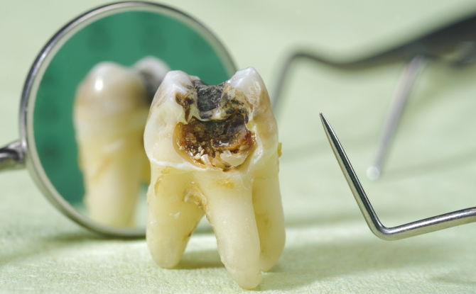 Dents pourries chez les enfants et les adultes: photos, raisons, que faire