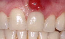 A cyst on the gum near a tooth in an adult and a child: causes, symptoms, removal, treatment and alternative therapy