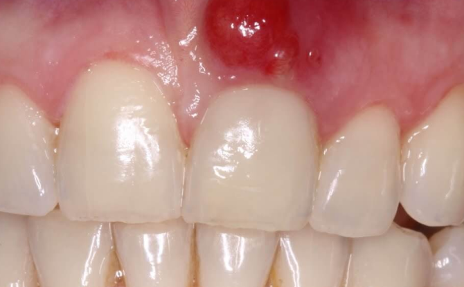 En cyste på tannkjøttet nær en tann hos en voksen og et barn: årsaker, symptomer, fjerning, behandling og alternativ terapi