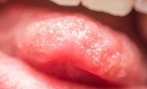 Herpes i tungan hos barn och vuxna: orsaker, symtom med foton och behandling