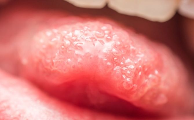 Herpes en la lengua en niños y adultos: causas, síntomas con fotos y tratamiento.