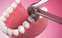 Extracción dental: indicaciones, contraindicaciones, pasos del procedimiento, posibles complicaciones.