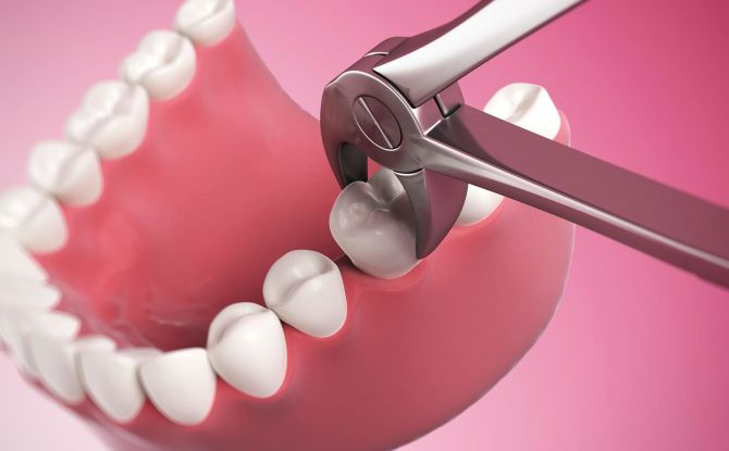 Extraction dentaire: indications, contre-indications, étapes de la procédure, complications possibles
