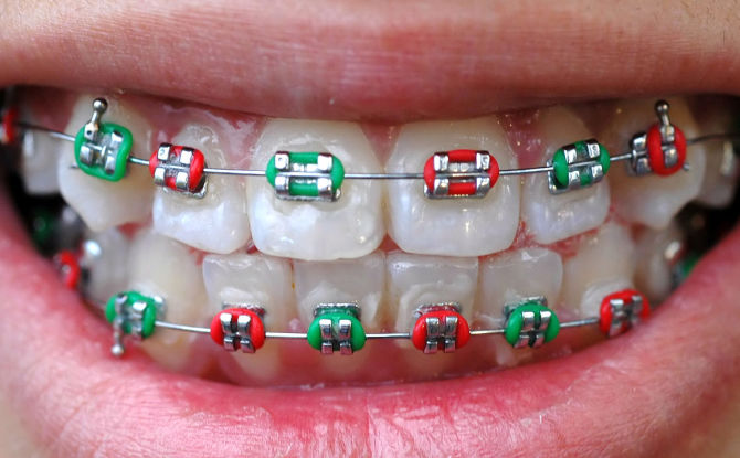 De la ce vârstă și până la vârsta în care se pot pune bretele pentru a alinia dinții