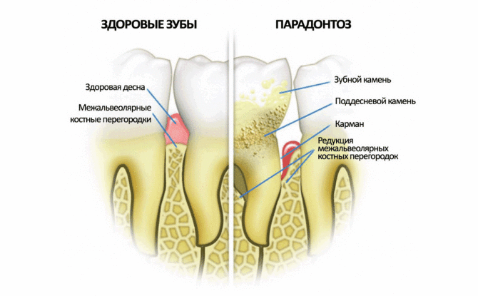 Trattamento della malattia parodontale delle gengive con farmaci efficaci