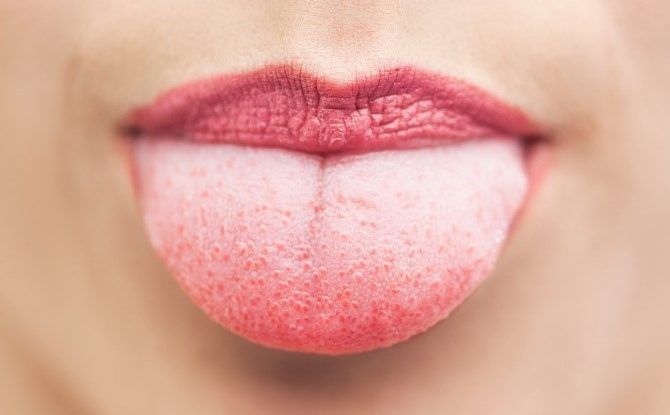 Placca gialla nella lingua: cause e trattamento