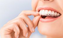 Cum se aliniază dinții față și mestecarea dinților fără bretele la copii și adulți