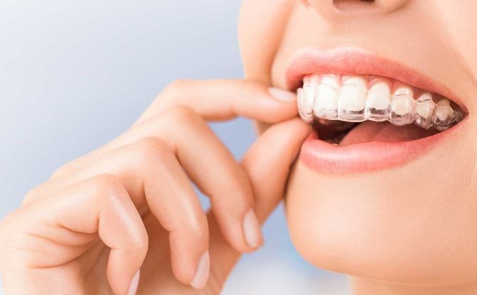 Çocuklarda ve yetişkinlerde ön ve çiğneme dişlerinin diş telleri olmadan nasıl hizalanacağı