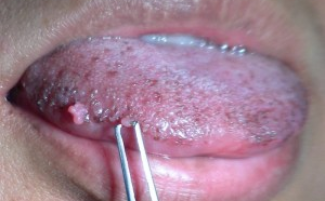 Cáncer papilar de la lengua