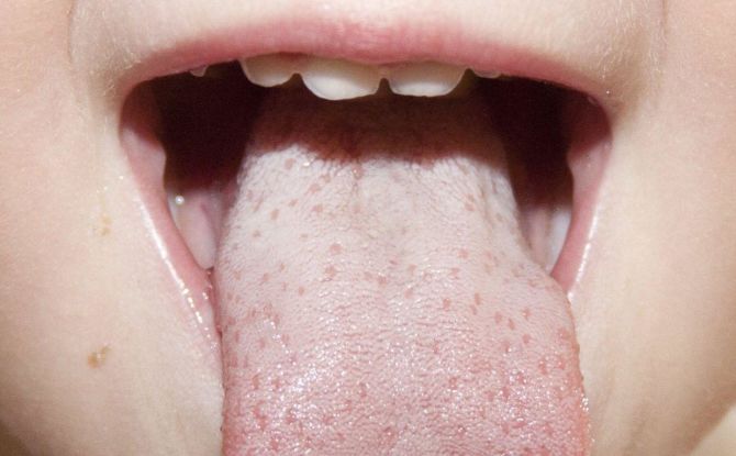 Hvid plak i barnets tunge: årsager og behandlingsmetoder